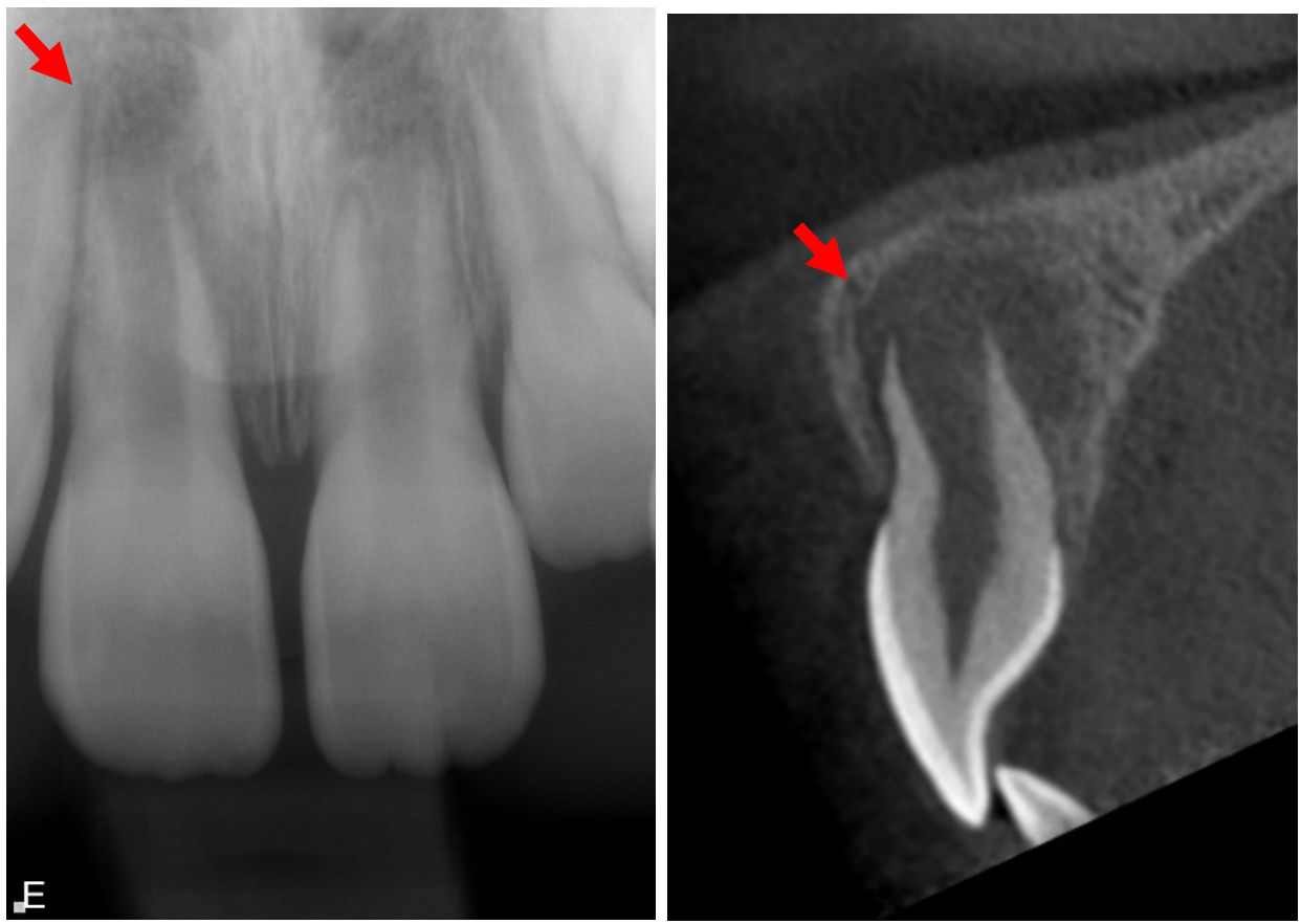 Radiologisk bild av en traumaskadad framtand med apikal radiolucens