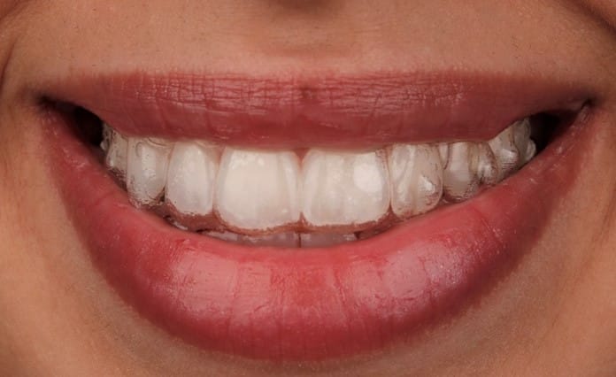 Närbild på ett leende med en transparent aligner på tänderna.