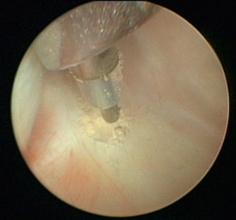 Endoskopisk borrning av ben i mellanörat vid minimalinvasivt kirurgiskt ingrepp
