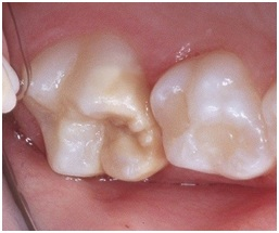 Första molar med emaljdefekt orsakad av Molar Incisor Hypomineralization (MIH)