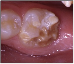Allvarlig skada på tandkrona till följd av Molar Incisor Hypomineralization (MIH)