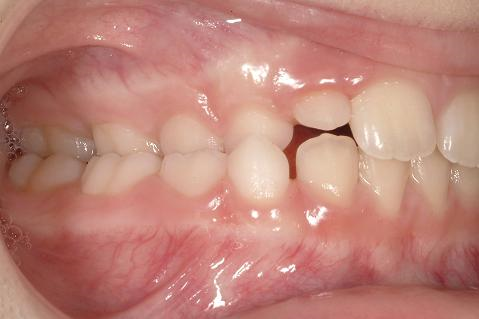 Klinisk bild på enkelsidigt korsbett hos barn, visande felaktigt buckal-lingualt tandförhållande