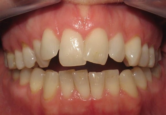 Frontbild av öppet bett med mellanrum mellan över- och underkäkens framtänder