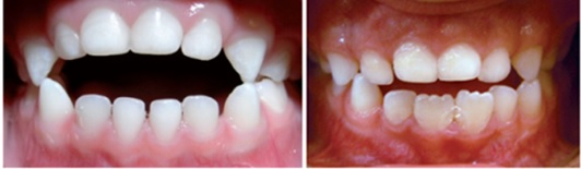 Frontal öppet bett hos barn i växelbett med kontaktlösa framtänder