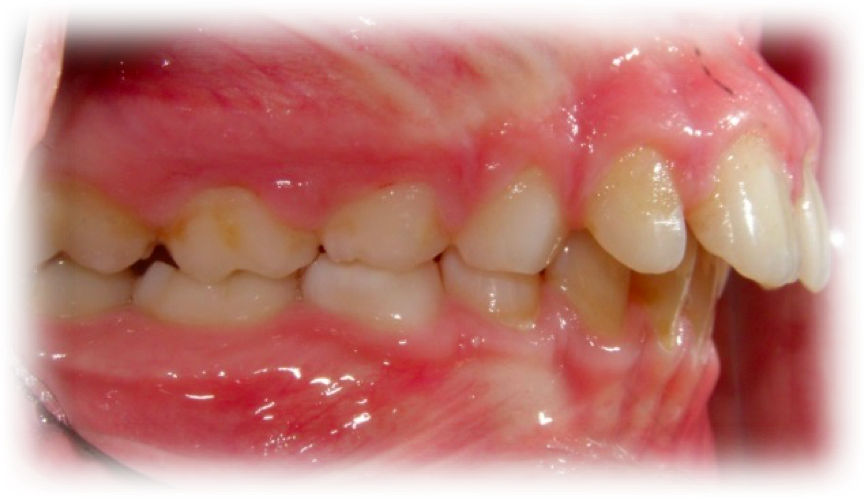 Klass II division 1 bettavvikelse i sidovy med framskjutna överkäksframtänder hos barn.
