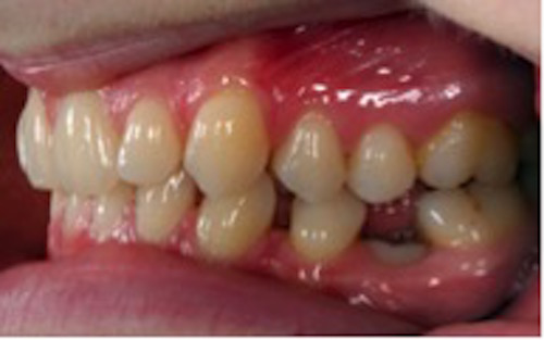 Sidovy av tandträngsel i över- och underkäken