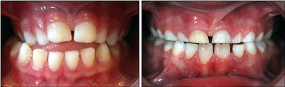 Kombination av kant-i-kant-bett och öppet bett hos barn med växelbett
