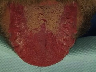 Rodnad och beläggningar på tungan – erytematös candidos hos patient med nedsatt immunförsvar