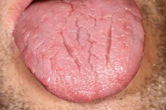Furrowed eller fissurerad tunga – vanlig anatomisk variant utan patologiskt värde