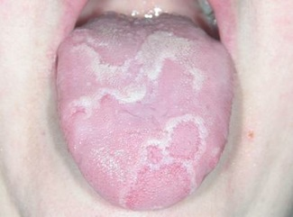 Tydligt mönster av geografisk tunga – avgränsade ljusa zoner med rödare centrum