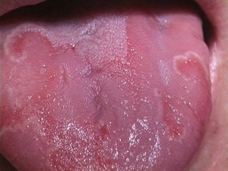 Oregelbundna röda och ljusa områden på tungan – typisk presentation av geografisk tunga