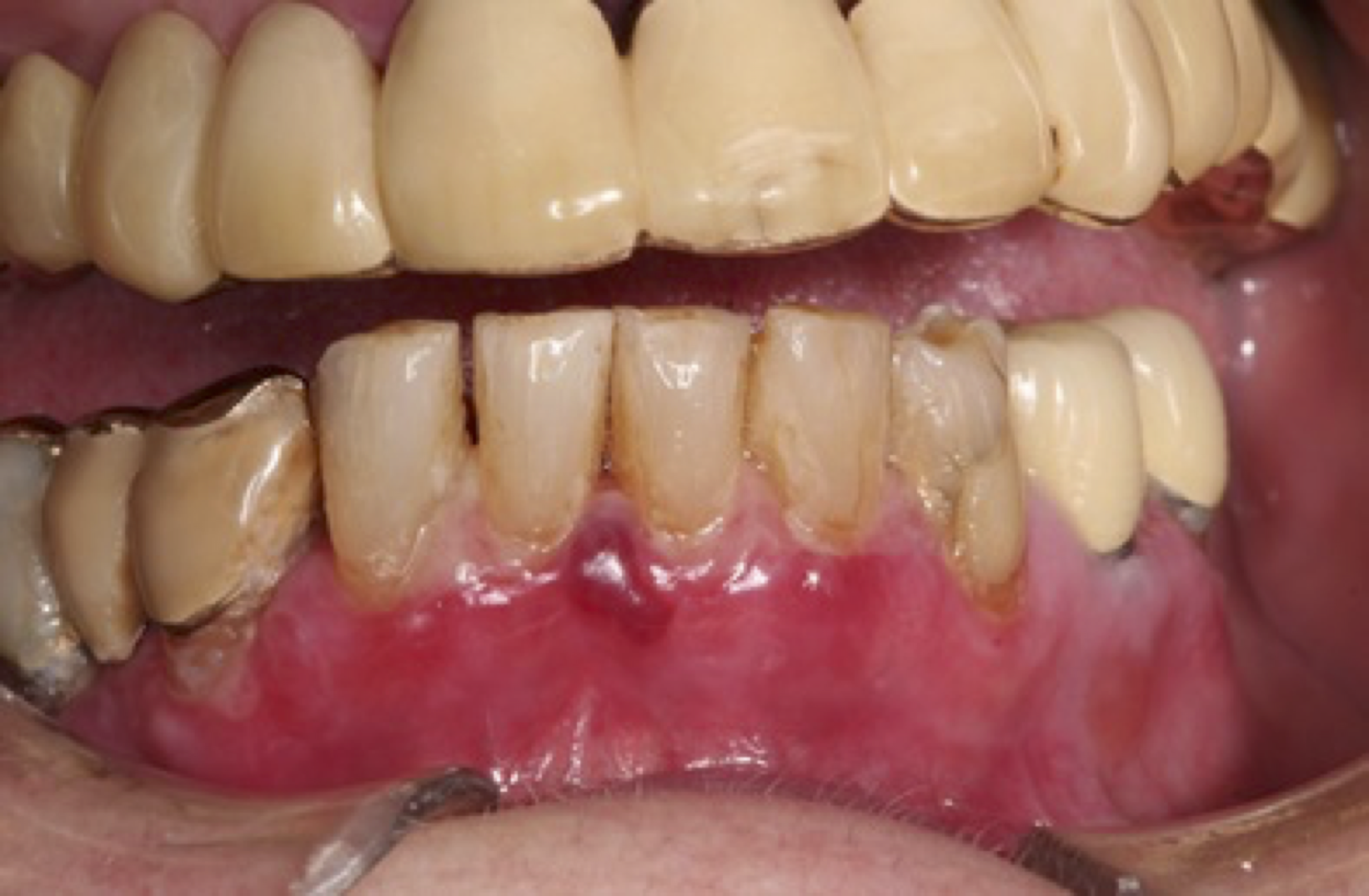 Blåsa i tandköttet vid mukös membranpemfigoid