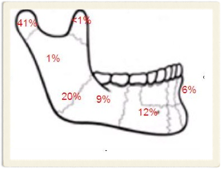 Skiss över mandibeln med procentuell fördelning av frakturområden