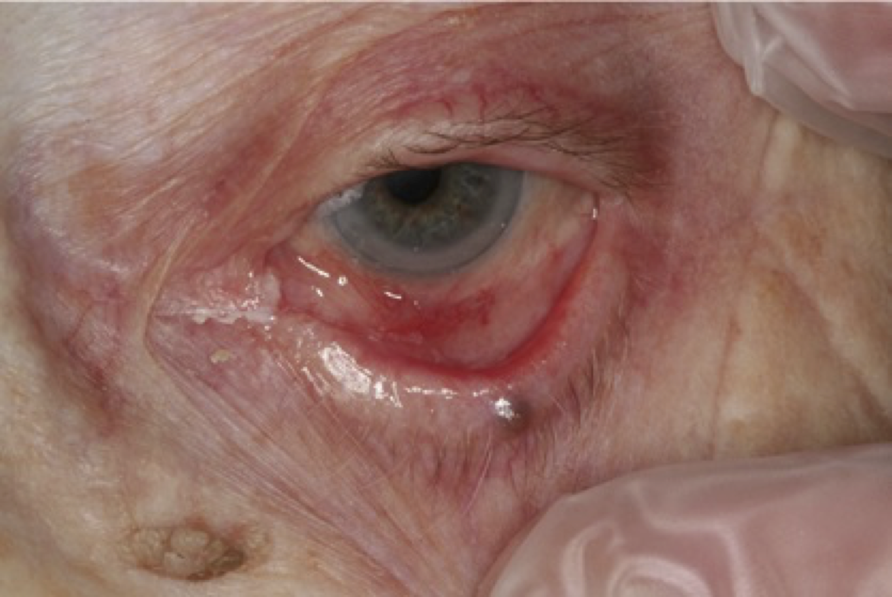 Ögoninflammation vid mukös membranpemfigoid med subepitelial blåsa