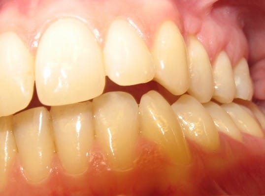 Sidoansikt av normalt överbett hos vuxen patient