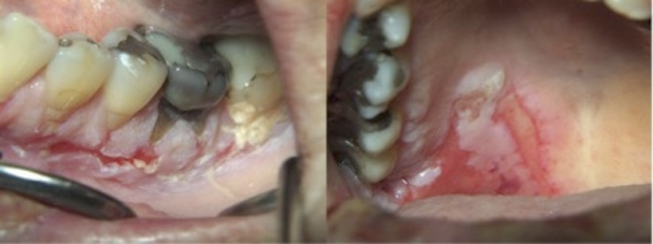 Klinisk bild på oral lichen planus med slemhinneförändringar i kinden