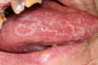 Lichen planus med vita stråk på tungans laterala del – typisk oralt slemhinneförändring