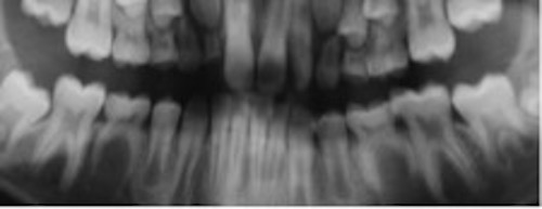 Panoramaröntgen som visar tandträngsel och kvarvarande primära tänder