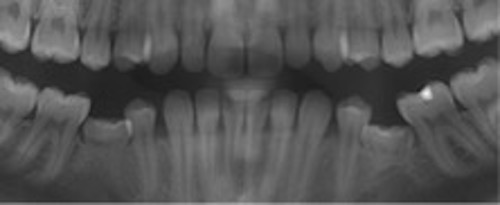 Panoramaröntgen som visar pågående eruption av permanenta tänder