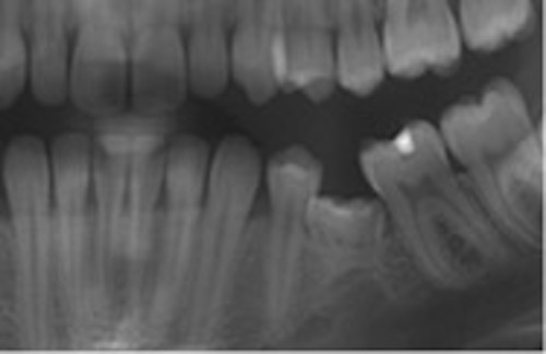 Panoramaröntgen som visar pågående eruption av permanenta tänder