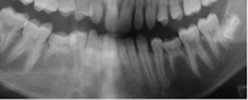 Röntgenbild som visar blandad bettutveckling hos ungdom