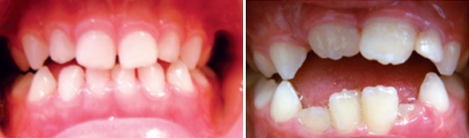 Barn med korsbett i sidopartierna och öppet bett framtill i växelbettstadiet