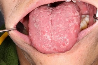 Multipla vita papler på tungans dorsala yta – differentialdiagnos innefattar papillär hyperplasi eller lichen