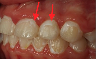 Vita fläckar på tändernas yta sett från sidan – synliga kritkariesangrepp på emaljen
