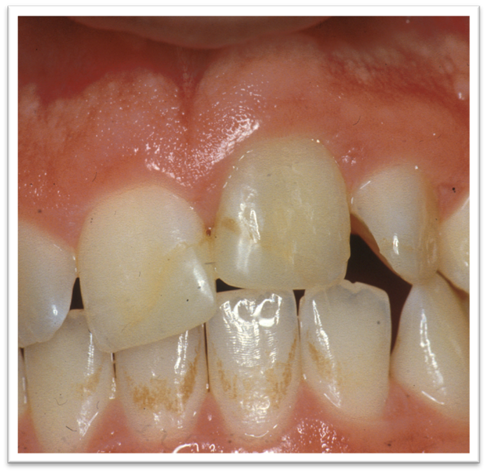 Ankylos av framtand med missfärgningar och tandytedefekter hos barn