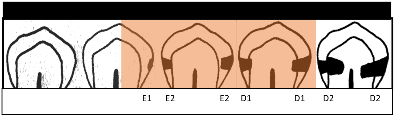 Illustration av kariesskador i olika stadier (E1, E2, D1, D2) från emalj till dentin för diagnostik och behandlingsplanering.