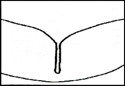 Illustration av en djup ocklusal fissur före applicering av fissurförsegling för att förebygga karies