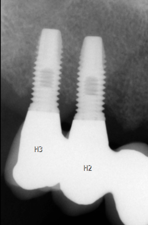 Röntgenbild som visar benförankring av två tandimplantat i överkäken