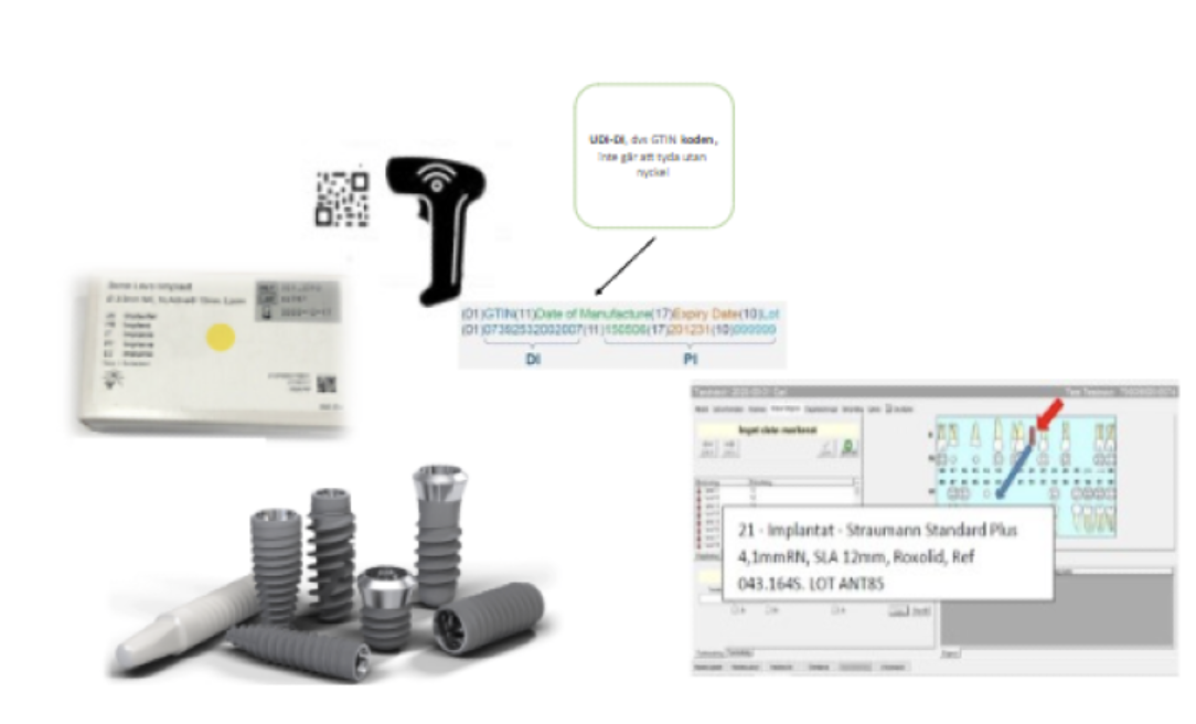 Illustration av hur UDI-kod (GTIN) registreras för dentalimplantat med streckkodsläsare, implantatförpackning, databasinmatning och implantatkomponenter.