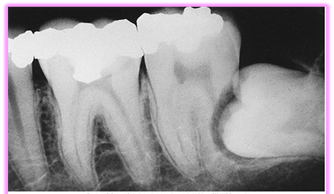 Röntgenbild som visar resorptionsskada på andra molaren orsakad av tryck från visdomstand.