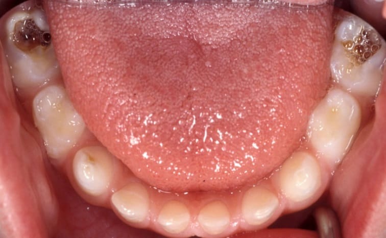 Foto av underkäken som visar trångställning med permanenta framtänder som bryter fram lingualt bakom mjölktänderna