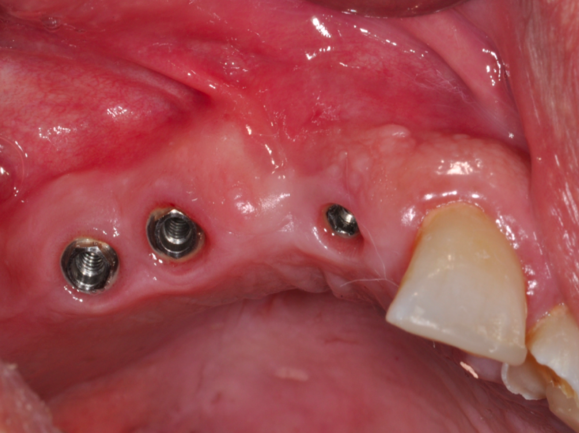 Närbild av tre tandimplantat i överkäken med intakt mjukvävnad