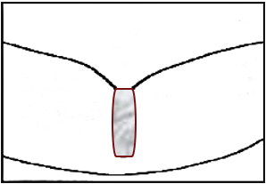 Illustration av en ocklusal fissur som har förseglats med fissurförsegling som profylaktisk åtgärd inom tandvård