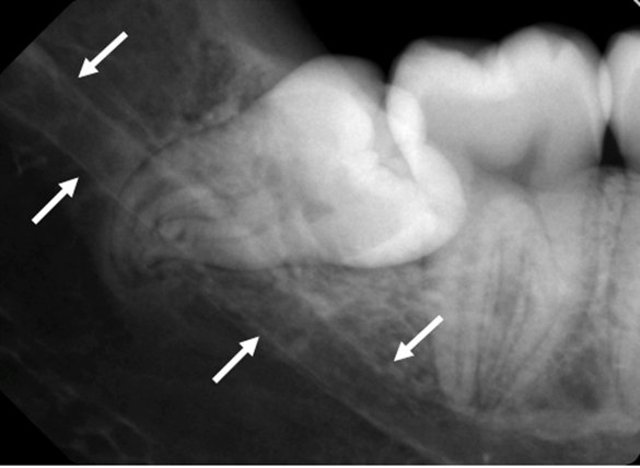 Intraoral röntgenbild som visar visdomstand i nära relation till mandibularkanalen med markerade pilar.