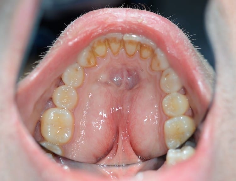 Klinsik bild på torus mandibularis som kräver kirurgisk åtgärd pga storlek