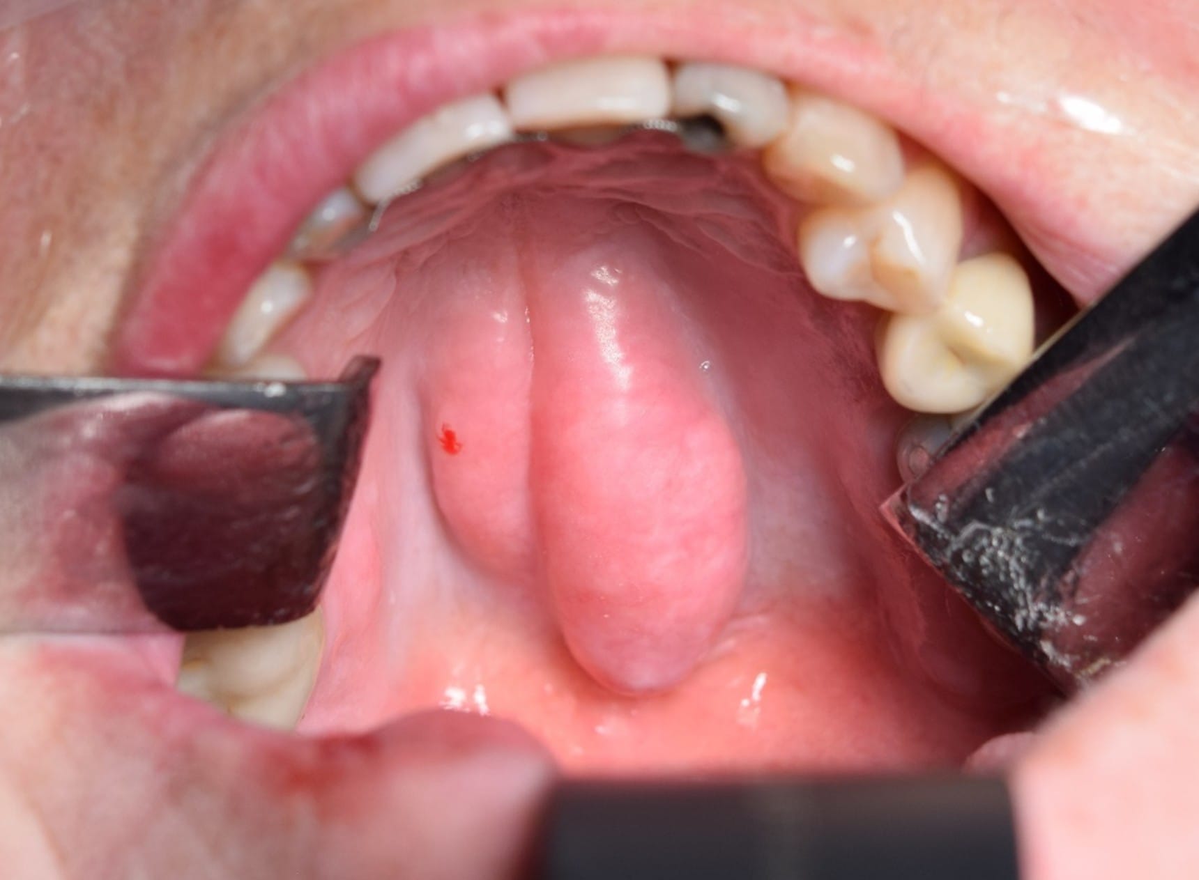 Torus palatinus som kräver kirurgisk åtgärd