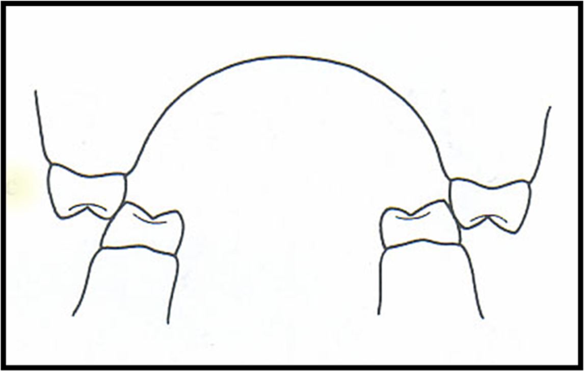 Illustration som visar i genomskärning hur ett saxbett ser ut.