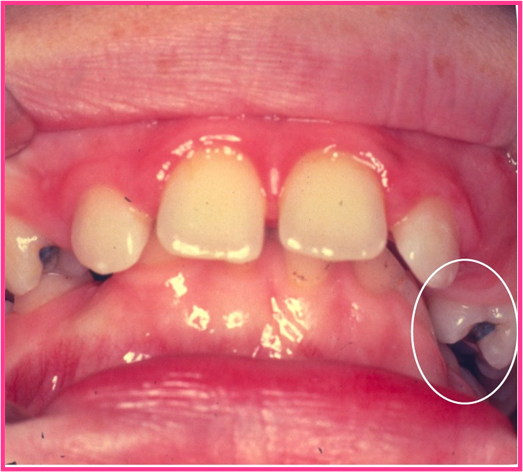 Kliniskt foto som exeplifierar ett saxbett där ena premolaren elongerat ned utanför tandbågen.