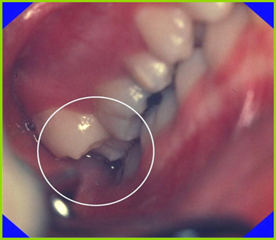 Kliniskt foto av en molar som elongerat i saxbett på höger sida.